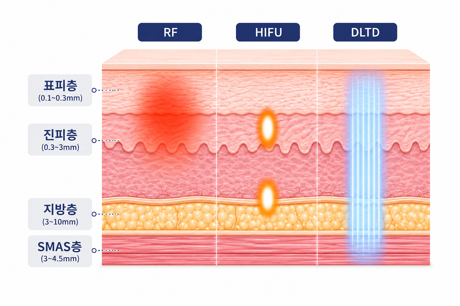 RF·HIFU·DLTD 에너지 도달층 비교